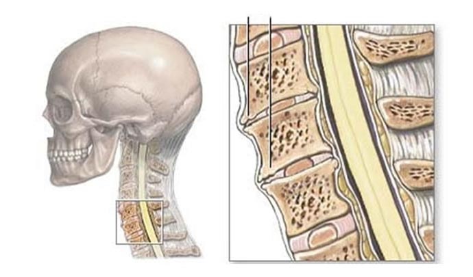 Espondilosis cervical